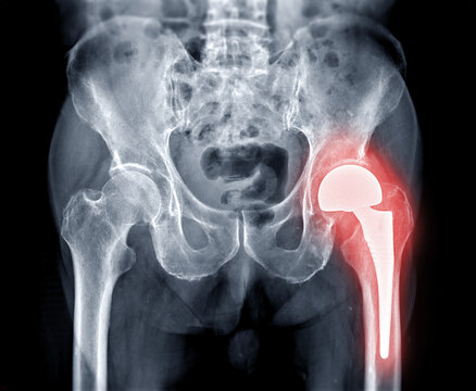 X-ray  pelvic bone or  both hip joint after total hip replacement.