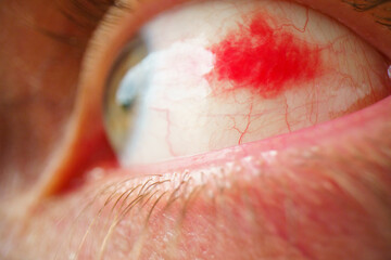 Subconjunctival hemorrhage - hyposphagma. Closeup of red bloodshot eye. Eye with burst blood vessels close up