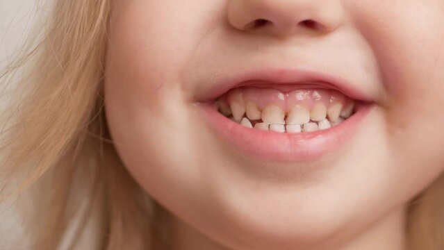 person smiles, shows teeth, yellow plaque, crooked teeth, malocclusion. childhood diseases