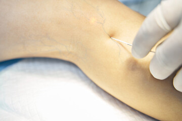 Close up photo of modern laser treatment of varicose