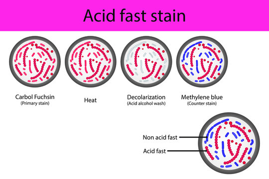 Acid fast staining microbiology lab technique steps diagram, using Carbol fuchsine and methylene blue vector illustration eps10