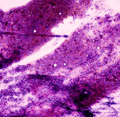 Microscopic image of Lymphoproliferative disorder at cervical lymph node cytology, smear show...