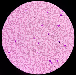 Microscopic image of Eosinophils, white blood cells, red blood cells background, Eosinophilia with...