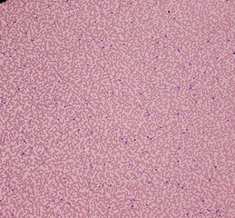 Microscopic image of Eosinophils, white blood cells, red blood cells background, Eosinophilia with lymphocytosis.