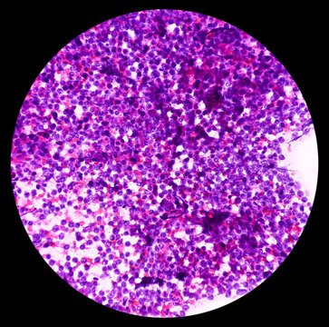 Microscopic image of Lymphoproliferative disorder at cervical lymph node cytology, smear show polymorphous of lymphocytes with histiocytes.