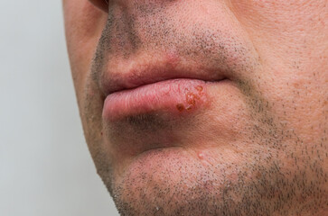 Naklejka premium Sore herpes on the lips of a man