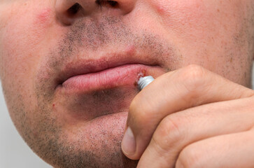Man applying ointment to herpes on lips for treatment	
