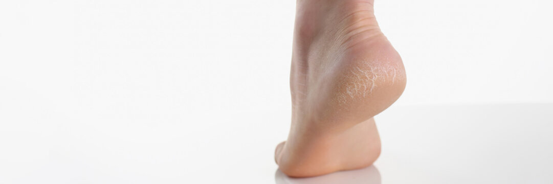 Single female leg or heel showing dried cracked heel with dried skin