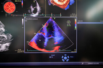 Ultrasound of the heart, Echocardiography (ultrasound) machine
