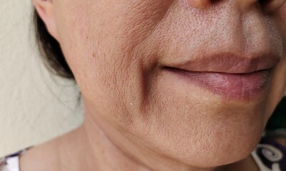 close up portrait showing the flabbiness adipose hanging beside the mouth, problem wrinkles and...