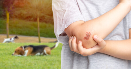 Closeup of an injured elbow of a child who was playing with the dog in the grass