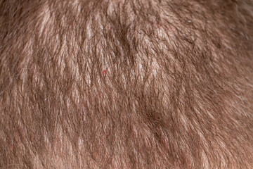 Hair loss adult man on a back of head. Irritated scalp skin.