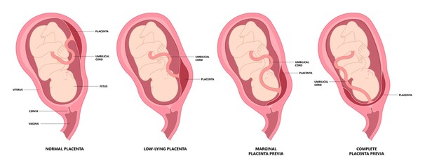 twins baby born defect vasa previa fetal infant c section nuchal cord fetus vessels funic labor growth low lying birth fluid of PROM test by increta cervix Bilobed sac uterus neck knotted contraction