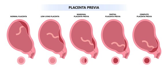 uterus contraction baby of vasa previa fetal infant born c section nuchal cord twins fetus defect vessels funic labor growth low lying birth fluid of PROM test increta cervix Bilobed sac neck knotted