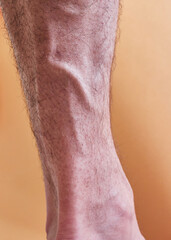 Leg of a man with a varicose vein