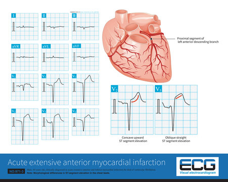Male, 64 years old, admitted with chest pain for 4 hours. The clinical diagnosis was extensive anterior and inferior myocardial infarction. The culprit vessel was the left anterior descending branch.