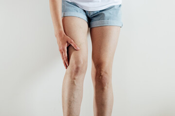 Woman with tired painful and spider varicose veins isolated on beige background. Healthcare problem, thrombophlebitis issue. laser surgery recovery and prevention, Compression Stockings Thigh - obrazy, fototapety, plakaty