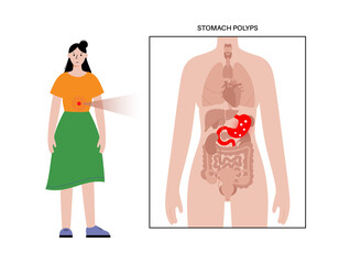 Stomach polyp disease