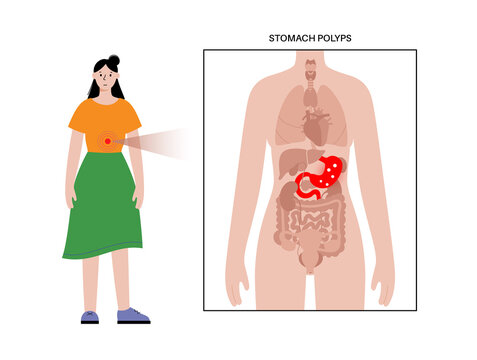 Stomach polyp disease
