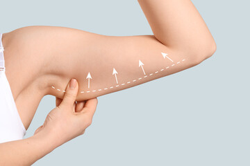 Arm of young woman after slimming on light background. Plastic surgery concept - obrazy, fototapety, plakaty