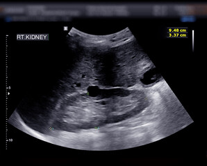 Ultrasound of urinary bladder  or KUB for  screening  renal and bladder disease. - obrazy, fototapety, plakaty