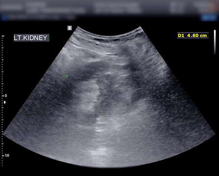 Ultrasound Of Urinary Bladder  Or KUB For  Screening  Renal And Bladder Disease.