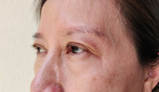 close up portrait showing the flabbiness and wrinkle beside the eyelid, problem blemish on the face of the woman, concept health care.