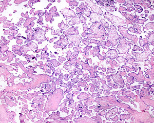 Placenta. Erythroblastosis fetal