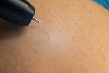 Process of permanent hair removal, removing unwanted hair using an electroepilation device,...