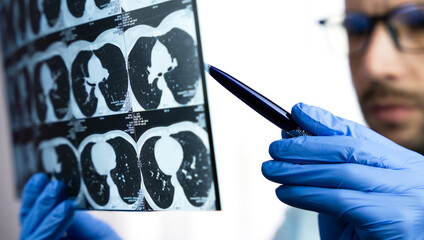 A male doctor examines a CT scan of a patient's lungs. Treatment of bronchitis, pneumonia,...