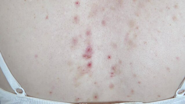Acne sequelae, torn pimples, skin itching on the back, dermatological problem. 