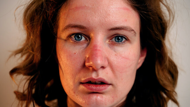 Female doctor during coronavirus pandemic covid-19 takes off glasses, hood from protective suit and mask, face marks are visible, red spots. Nurse inhales and exhales air with relief.Close up portrait