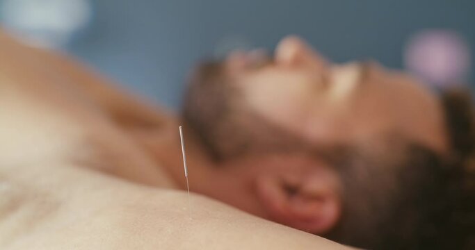 Closeup of an acupuncture needle in client being treated at a holistic clinic. Young sleeping man lying down, releasing muscle tension in arm and shoulder with Ayurvedic treatment. Injury pain relief