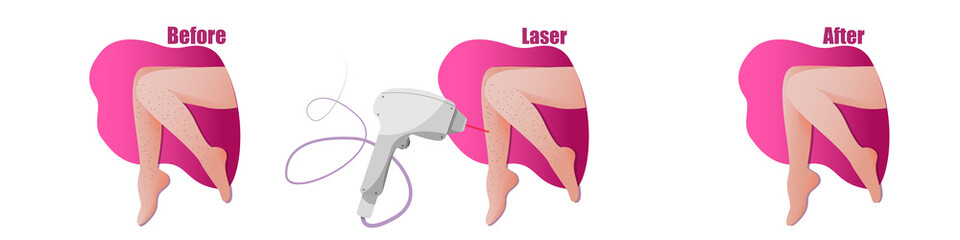 vector leg epilation banner, female legs, smooth skin, layout with the result of the procedure, hardware cosmetology