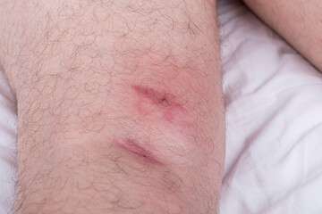 Fototapeta premium male legs with hair are lying on a white sheet. there are many small redness