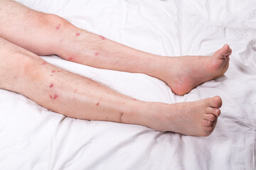 male legs with hair are lying on a white sheet. there are many small redness - obrazy, fototapety, plakaty