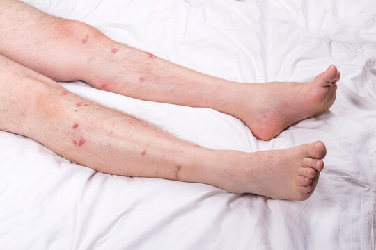 male legs with hair are lying on a white sheet. there are many small redness