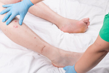 male legs with hair are lying on a white sheet. there are many small redness - obrazy, fototapety, plakaty