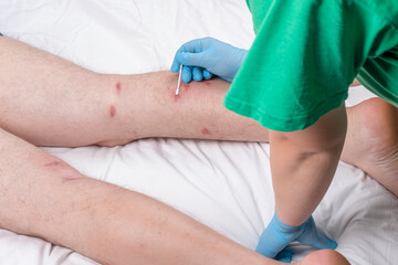 male legs with hair are lying on a white sheet. there are many small redness