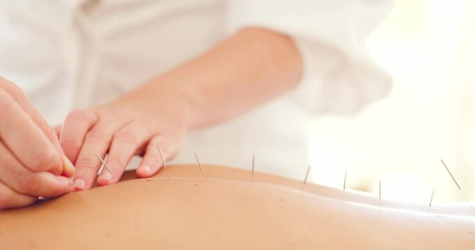 Closeup of a female masseuse with acupuncture needles treating an unknown woman patient in a clinic. Therapist inserting needles in clients back. Alternative therapy to reduce stress and tension
