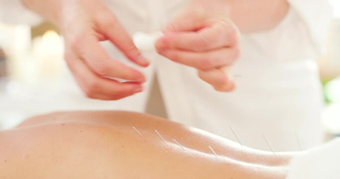 Closeup of acupuncture, hands removing filiform needles from a patients back. An Acupuncturist removing needles after dry needling. Alternative therapy to reduce stress, tension and inflammation