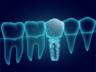 Illustration of teeth and dental implant on dark blue background