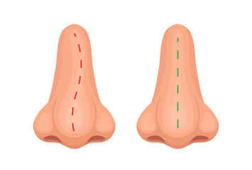Crooked and correct nose. Nose before and after treatment. Vector illustration