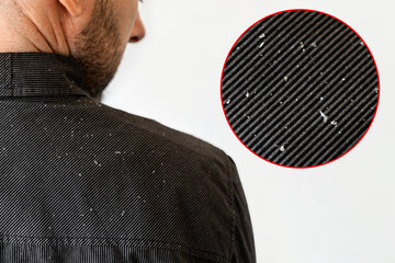 A bearded man in a black shirt, a close up view of the shoulder covered with dandruff. White...