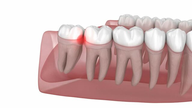 Wisdom tooth and gum inflammation, extraction of teeth. Medically accurate tooth 3D animation