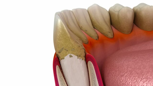 Periodontitis, gum recession process. Medically accurate 3D animation