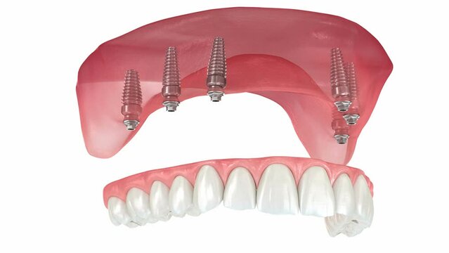 Maxillary prosthesis with gum All on 6 system supported by implants. Dental 3D animation