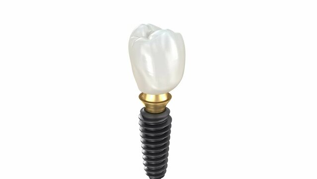 Ceramic crown, custom implant abutment and implantat instalation process. Medically accurate 3D animation.