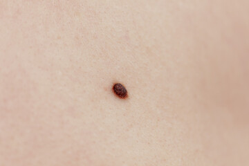 Precancerous mole - birthmark is potentially cancerous melanoma