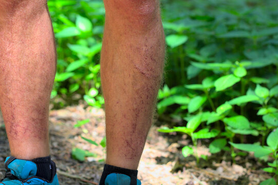 Man showing injured legs after orienteering. Running across blackberry and nettle bushes without any leg protection.